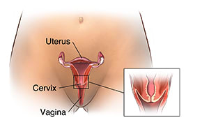 Front view of female pelvis showing cross section of uterus, cervix, and vagina, with close-up of cervix.