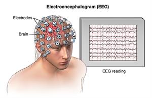 Abnormal electrical impulses during a seizure